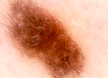 nevo dermatoscopia copia